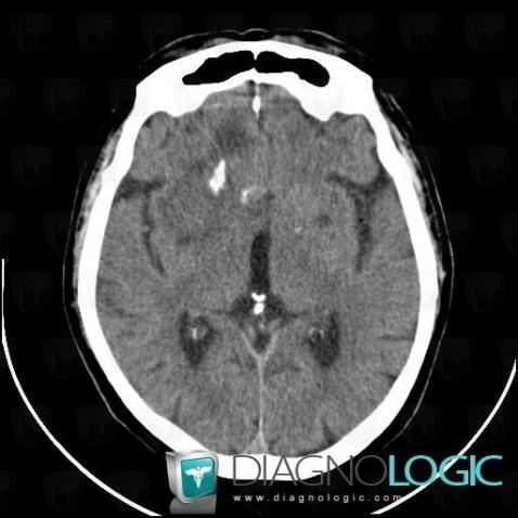 Low grade astrocytoma, Cerebellar hemisphere, Theoretical