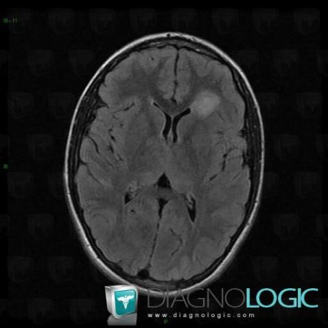 Low grade astrocytoma, Cerebral hemispheres, MRI