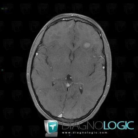 Low grade astrocytoma, Cerebral hemispheres, MRI