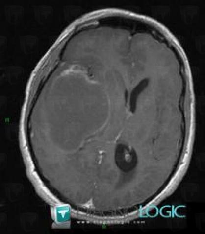 Low grade astrocytoma, Cerebral hemispheres, MRI