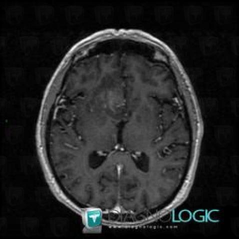 Low grade astrocytoma, Cerebral hemispheres, MRI