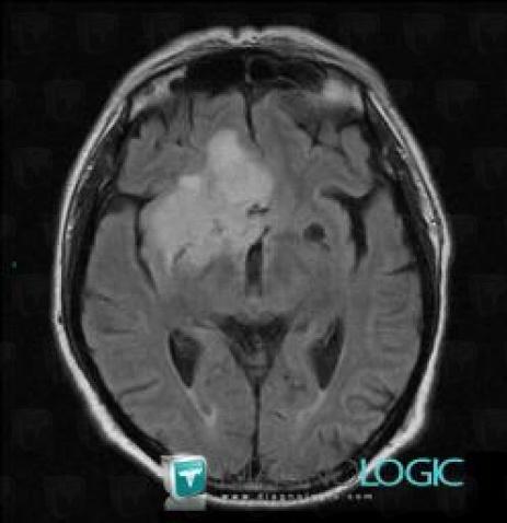 Low grade astrocytoma, Cerebral hemispheres, V4 and vermis, Theoretical