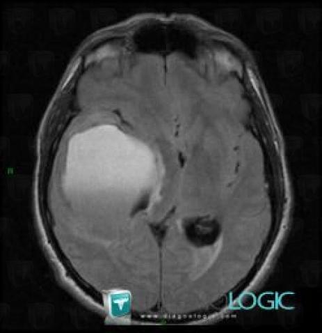 Low grade astrocytoma, Cortico subcortical region, Cerebral hemispheres, MRI