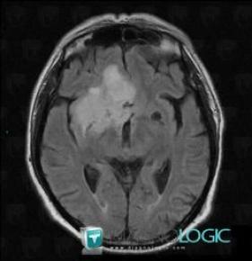 Low grade astrocytoma, Cortico subcortical region, Cerebral hemispheres, MRI
