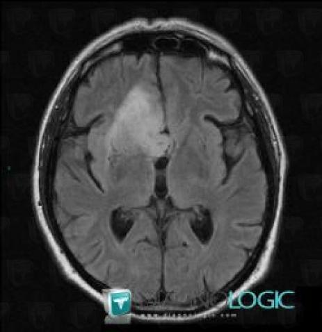 Low grade astrocytoma, Ventricles / Periventricular region, Corpus callosum, MRI