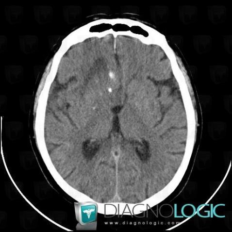 Low grade astrocytoma, Ventricles / Periventricular region, CT