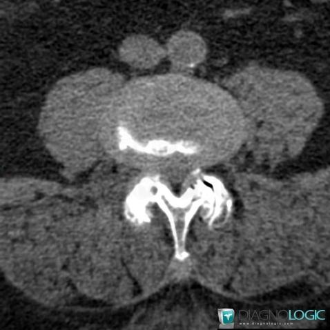 Lumbar spinal stenosis, Vertebral body / Disk, CT