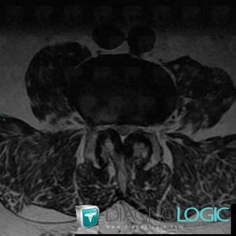 Lumbar spinal stenosis, Vertebral body / Disk, MRI