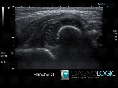 Luxation congénitale-hanche, Articulation coxo fémorale, Echographie