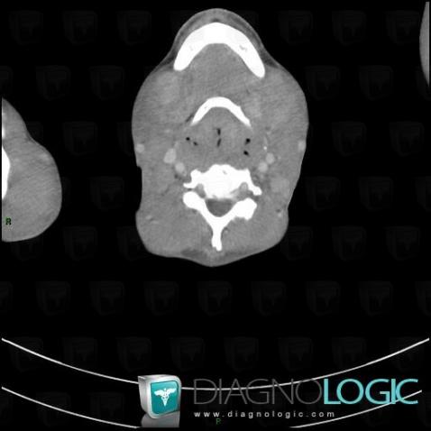 Lymphadenopathy, Deep neck spaces, CT