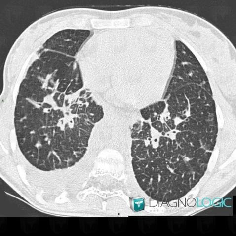 Lymphangiectasia, Airways, CT