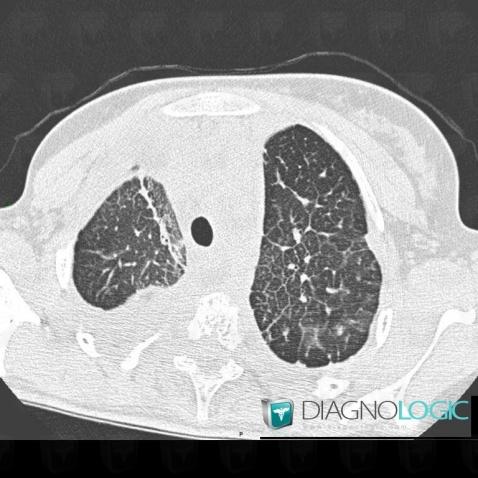 Lymphangiectasia, Pulmonary parenchyma, CT