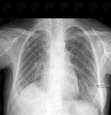 Lymphangiectasie, Parenchyme pulmonaire, Radio