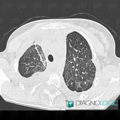 Lymphangiectasie, Parenchyme pulmonaire, Scanner