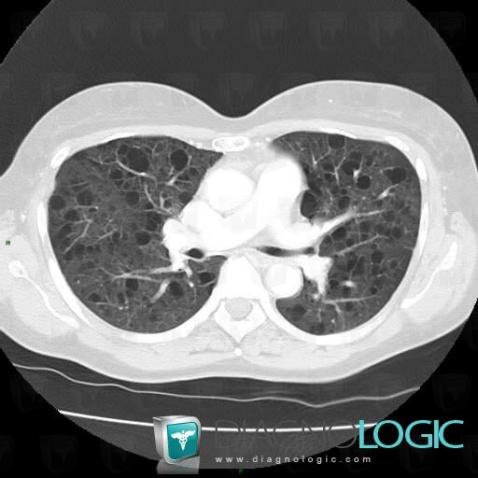 Lymphangioléiomyomatose, Parenchyme pulmonaire, Scanner