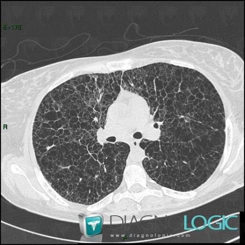 Lymphangioleiomyomatosis, Pulmonary parenchyma, CT