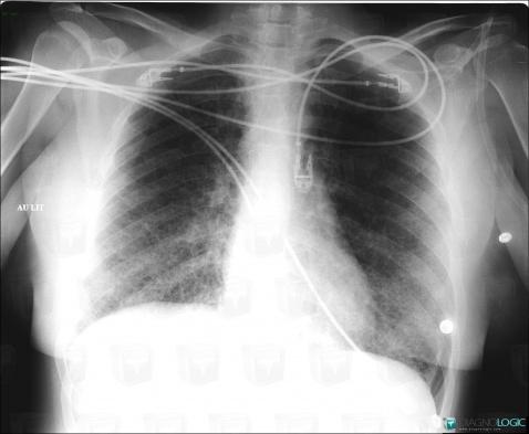 Lymphangioleiomyomatosis, Pulmonary parenchyma, X rays