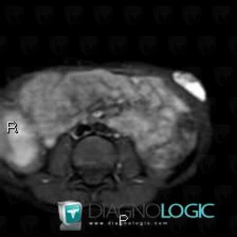 Lymphangioma, Abdominal wall, MRI