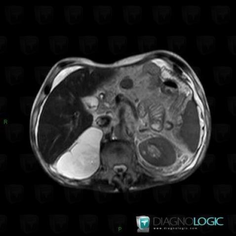 Lymphangioma, Adrenal glands, MRI