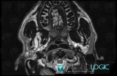 Lymphangioma, Deep facial spaces, MRI