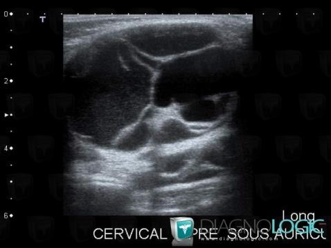 Radiology case : Lymphangioma (US) - Diagnologic