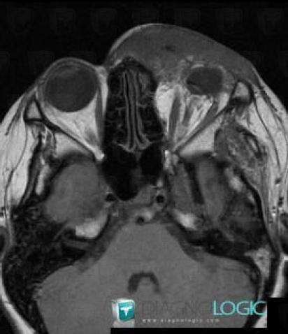 Lymphangioma, Eye, MRI