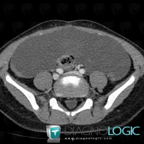 Lymphangioma, Mesentery / Peritoneum, CT