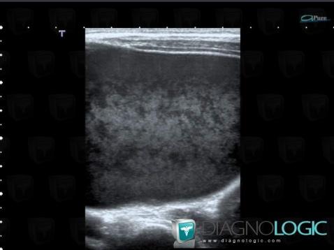 Lymphangioma, Mesentery / Peritoneum, US