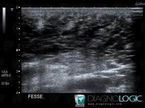 Lymphangioma, Muscles - Thigh, US