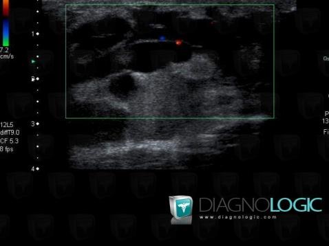 Lymphangioma, Other soft tissues/nerves - Leg, US