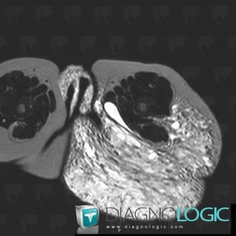 Lymphangioma, Other soft tissues/nerves - Pelvis, MRI