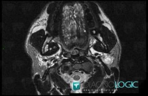 Lymphangioma, Parotid and other salivary glands, MRI