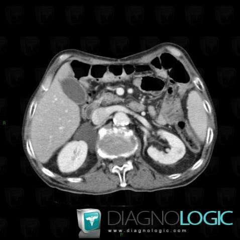 Lymphangioma, Retroperitoneum, CT