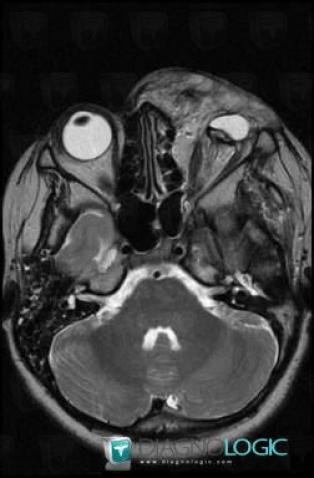 Lymphangioma, Soft tissues - Head and neck, MRI