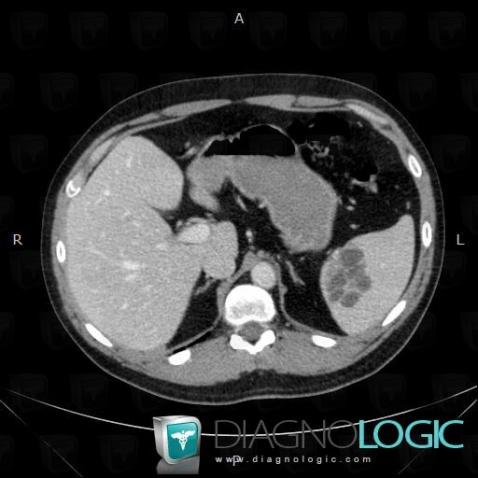 Lymphangioma, Spleen, CT