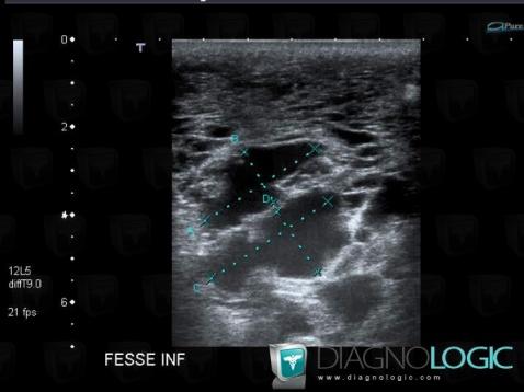 Lymphangiome , Autres parties molles/nerfs - Bassin, Autres parties molles/nerfs - Cuisse, Echographie