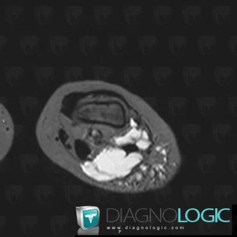 Lymphangiome , Autres parties molles/nerfs - Genou, IRM