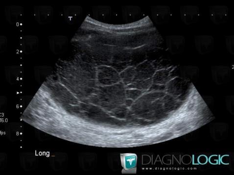 Lymphangiome , Mésentère / Péritoine, Echographie