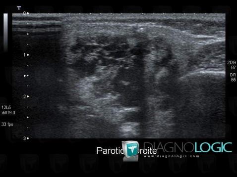 Lymphangiome , Parotide et autres glandes salivaires, Echographie