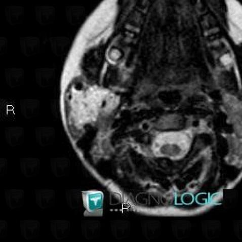 Lymphangiome , Parotide et autres glandes salivaires, IRM