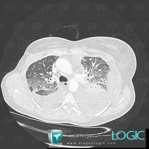 Lymphangite carcinomateuse, Parenchyme pulmonaire, Scanner