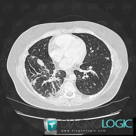 Lymphangite carcinomateuse, Parenchyme pulmonaire, Scanner