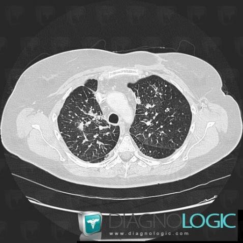 Lymphangite carcinomateuse, Parenchyme pulmonaire, Scanner