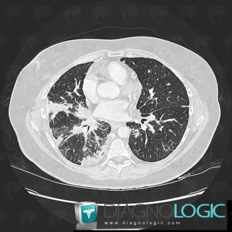 Lymphangite carcinomateuse, Parenchyme pulmonaire, Scanner