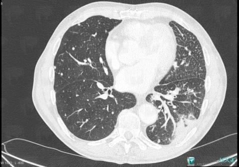 Lymphangite carcinomateuse, Parenchyme pulmonaire, Voies aériennes, Scanner