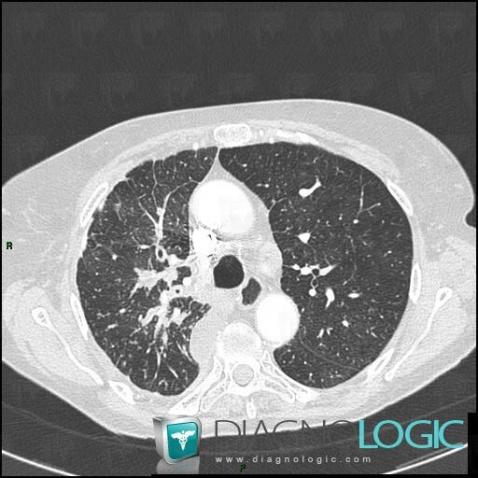 Lymphangitic carcinomatosis, Airways, CT