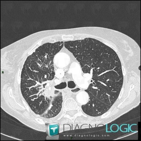 Lymphangitic carcinomatosis, Pulmonary parenchyma, CT