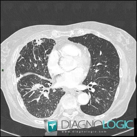 Lymphangitic carcinomatosis, Pulmonary parenchyma, CT