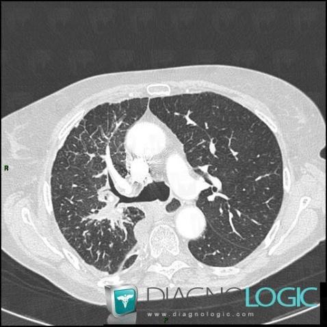 Lymphangitic carcinomatosis, Pulmonary parenchyma, CT