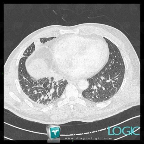 Lymphangitic carcinomatosis, Pulmonary parenchyma, CT